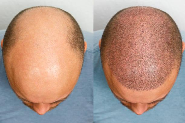 Hair Transplant in Punawale | Dr. Nisha Tripathi – Aesthetic Plus Clinic