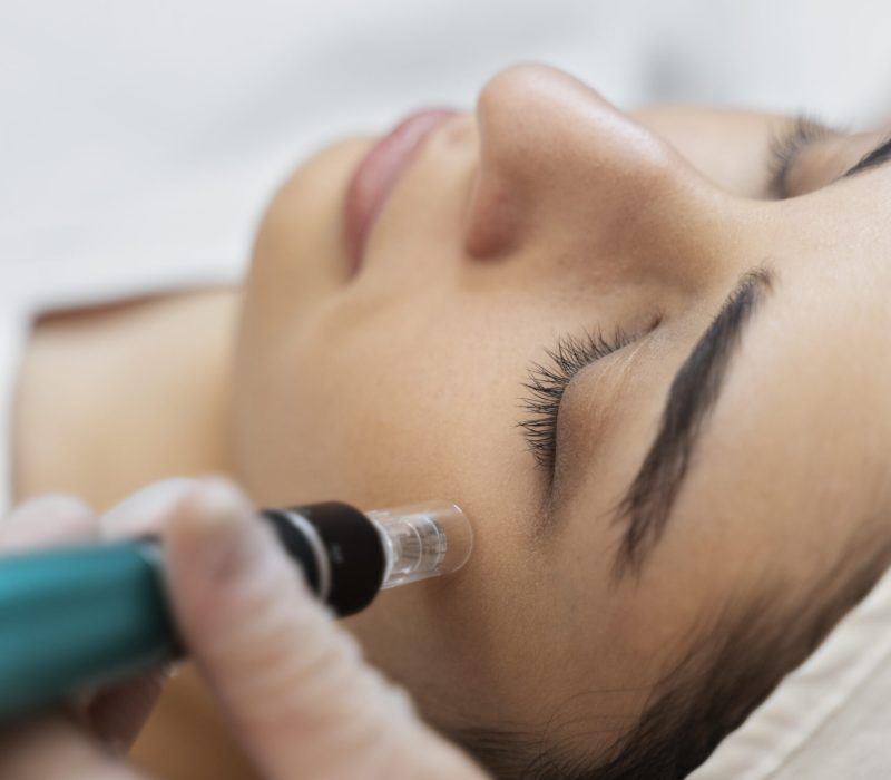 person-getting-micro-needling-beauty-treatment